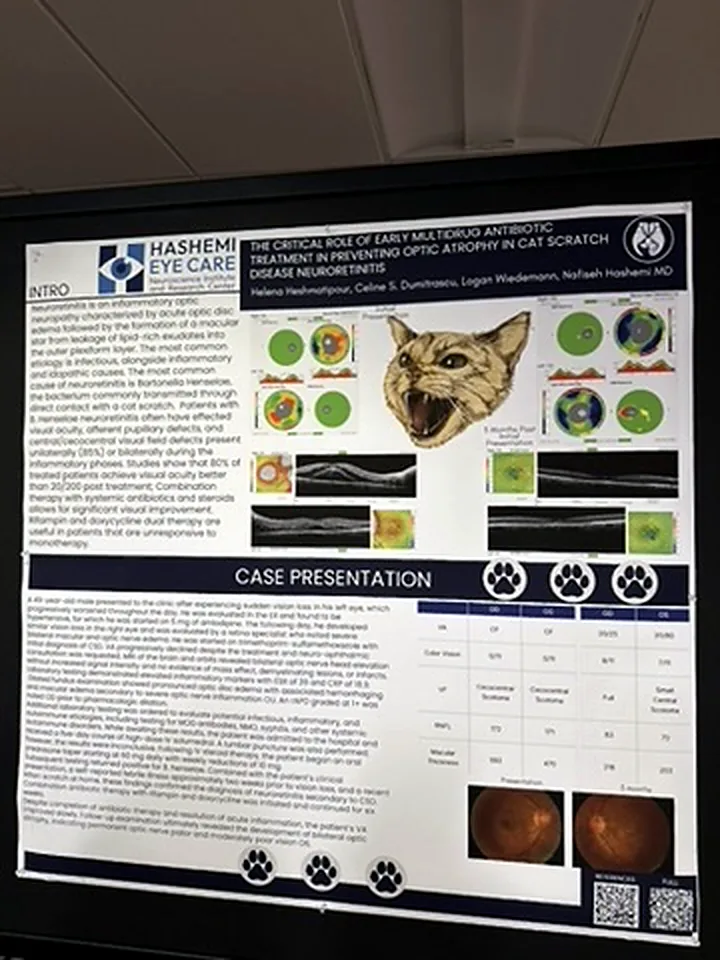 Hashemi Eye Care case presentation research poster displayed at NANOS