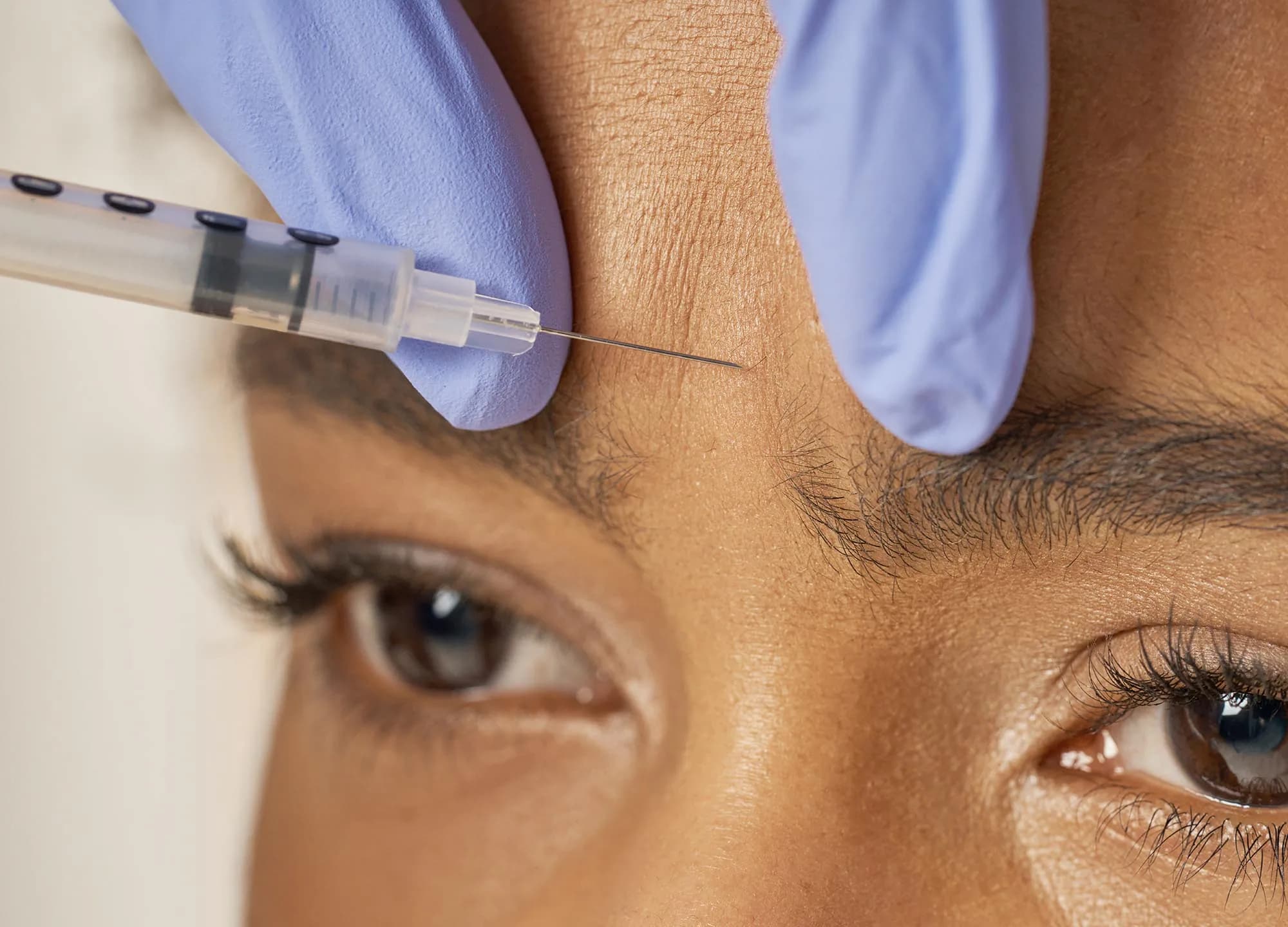 close up of a patient's forehead as a botox needle is being injected