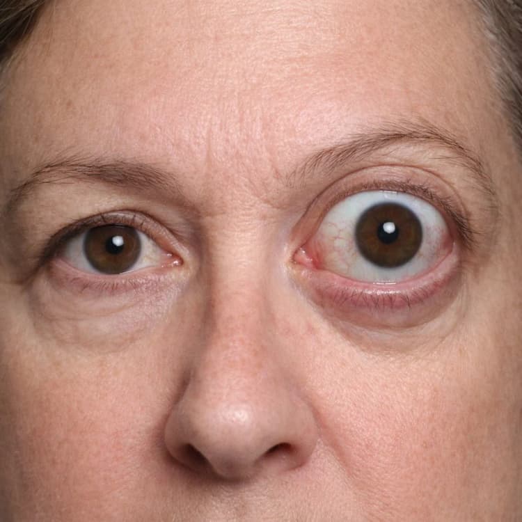 Close-up of a person with unilateral proptosis showing one eye significantly bulging forward with visible sclera above and below the iris, compared to the normal opposite eye