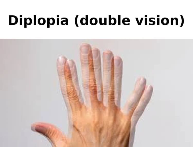 Example of what double vision can look like, with overlapping offset images of one hand