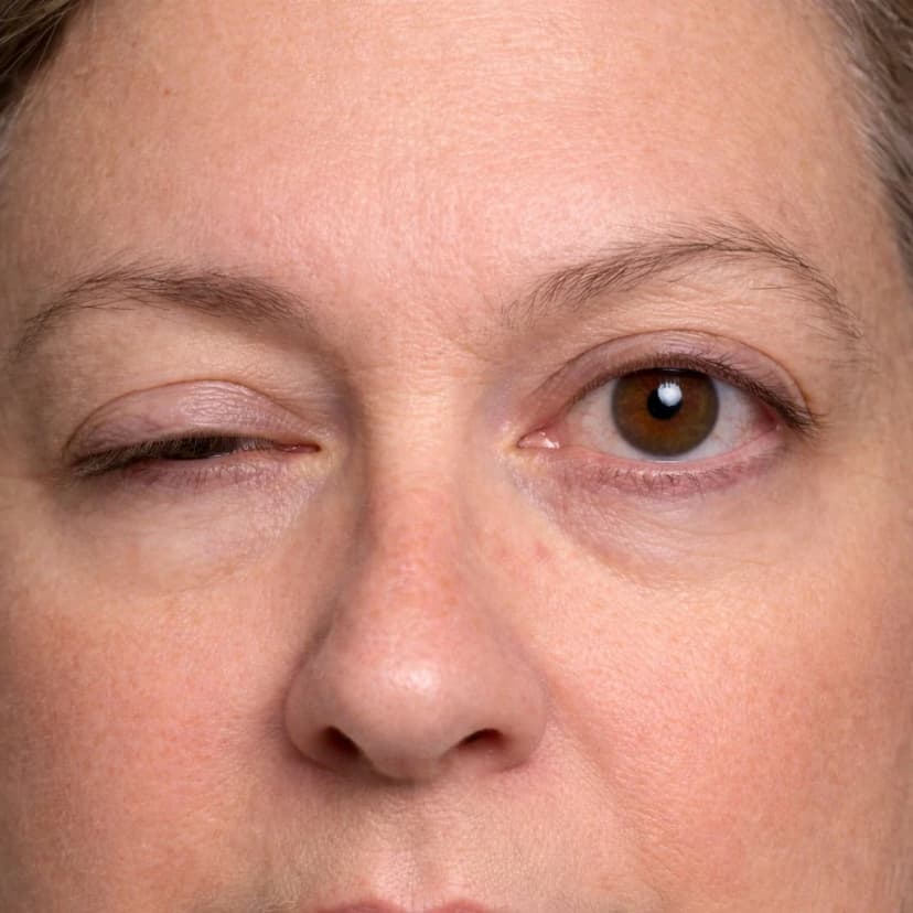 Unilateral Ptosis (Drooping Eyelid) - Clinical Presentation of Severe Acquired Ptosis Close-up of a person with severe unilateral ptosis showing the left upper eyelid drooping almost completely shut, compared to the normal open right eye - a clinical example of acquired ptosis