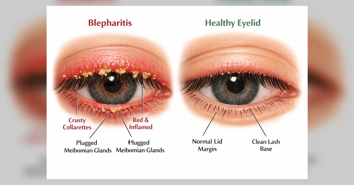 Blepharitis: Causes, Treatment & How to Manage Eyelid Inflammation ...