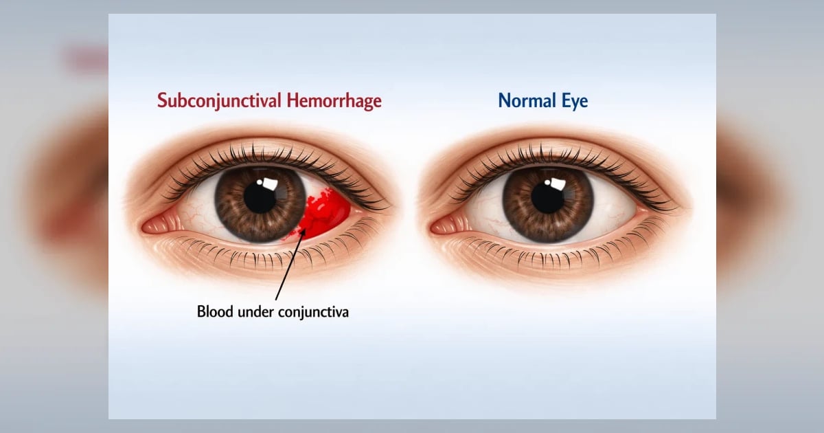 Subconjunctival Hemorrhage: Red Eye From Broken Blood Vessel | Hashemi ...