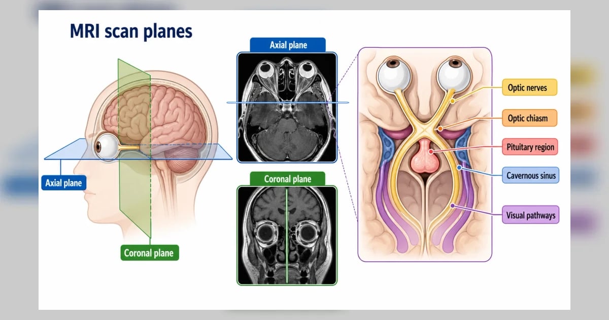 Mri Orbits Machine MRI Brain & Orbits: Purpose, Procedure & What It Shows | Hashemi Eye Care