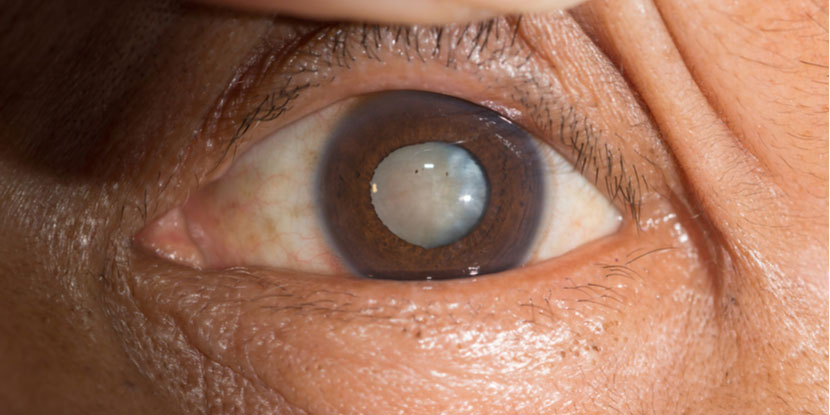 image of patient with cataracts
